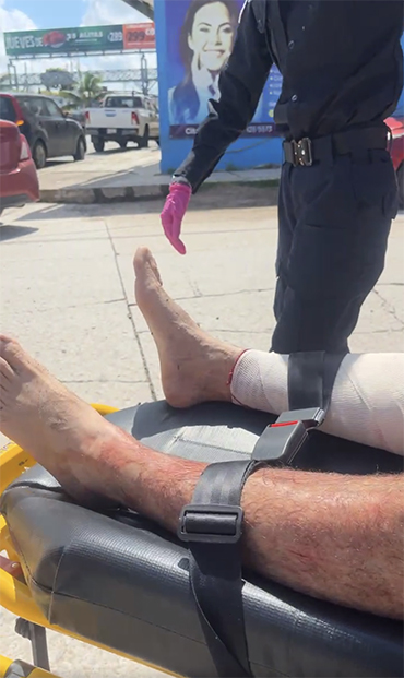 Ataque de cocodrilo deja herido a pescador en Altamira 1 PIERNA
